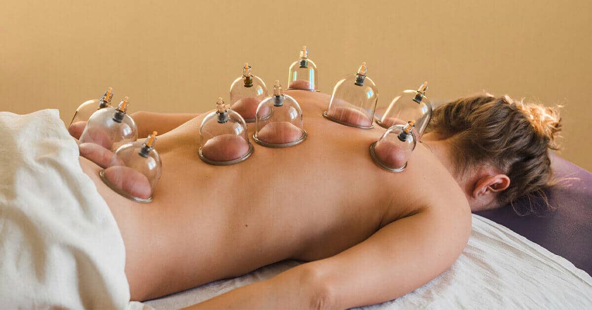 Terapia con ventosas aplicada en la espalda